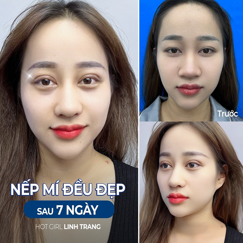 Nếp mí đều đẹp vào form sau 7 ngày