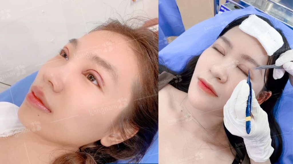 Cắt mí mắt bao lâu thì cắt chỉ? một số lưu ý về thời gian cắt chỉ