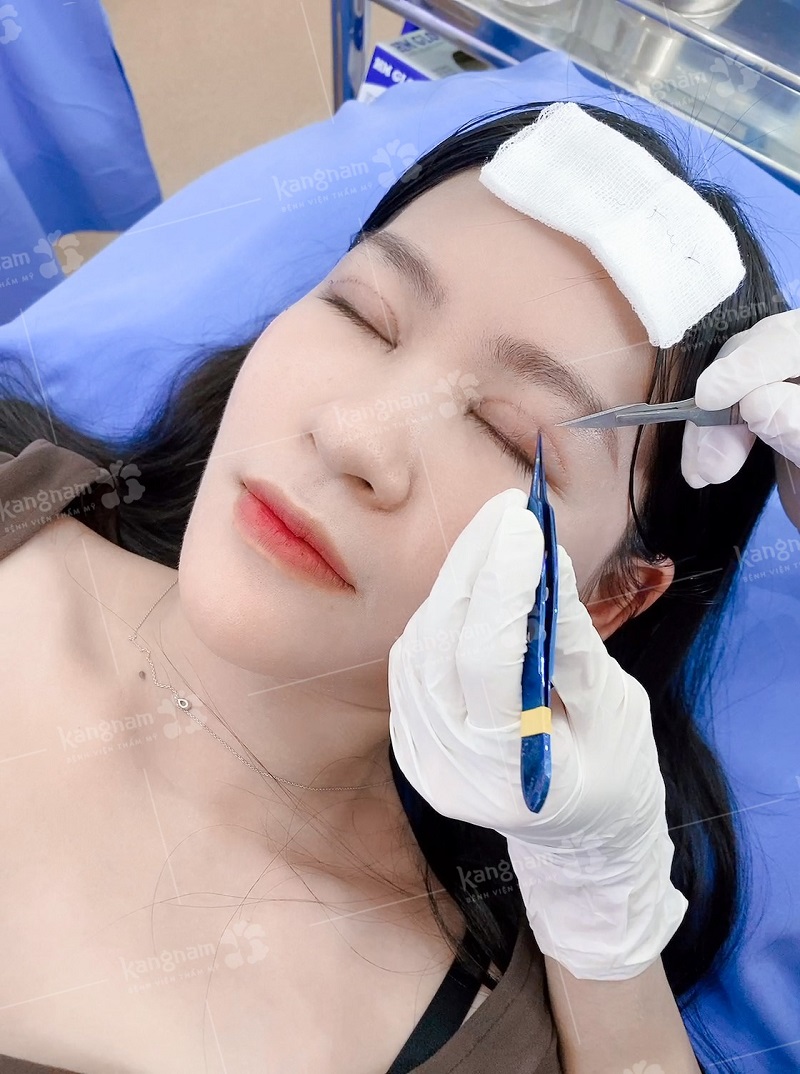 Quá trình cắt chỉ diễn ra nhanh, không gây đau