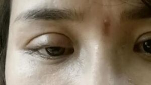Cắt mí mắt bị sâu do đâu? Một số giải pháp khắc phục nhanh