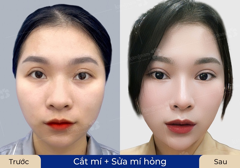 Chỉnh sửa cắt lại mí mắt