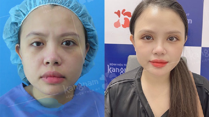 Bệnh viện Thẩm mỹ Kangnam thực hiện thành công điều chỉnh lại nếp mí cho khách hàng