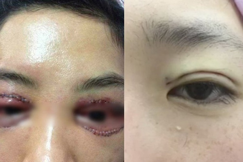 Mí mắt bị nhiễm trùng, sưng tấy kéo dài