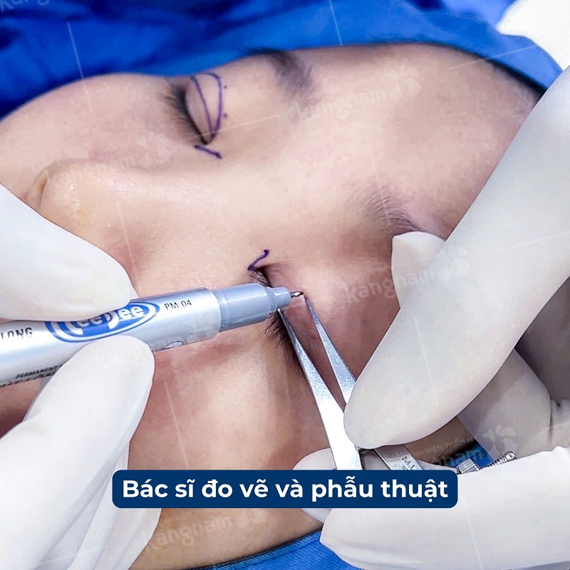 Bác sĩ sẽ đo vẽ, phác thảo tạo nếp mí mới