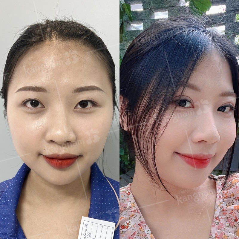 Cắt mí không làm tổn thương hay ảnh hưởng đến thị lực