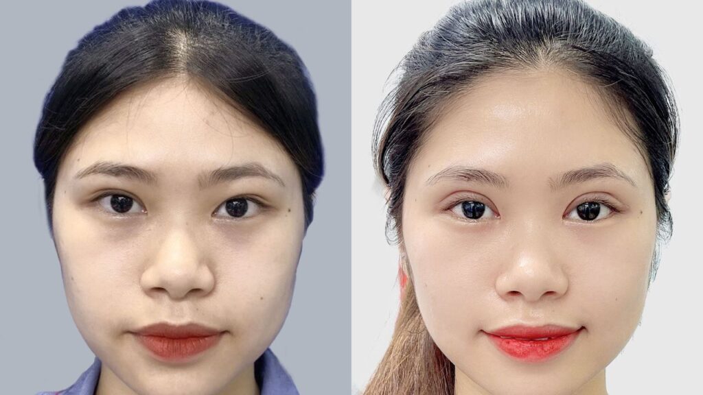 Cắt mí mấy tháng thì đẹp tự nhiên ? các mốc thời gian quan trọng