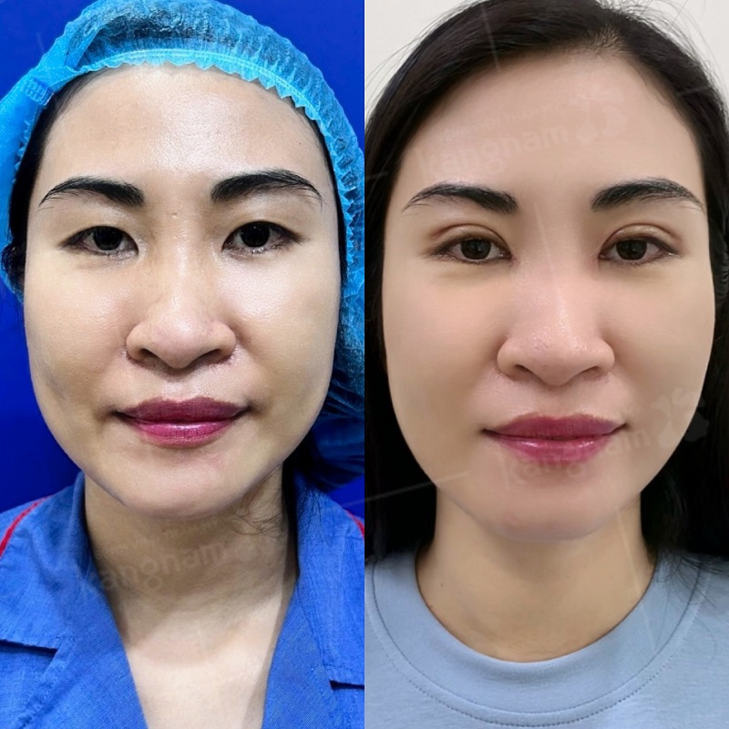 Mí mắt ổn định vào nếp tự nhiên
