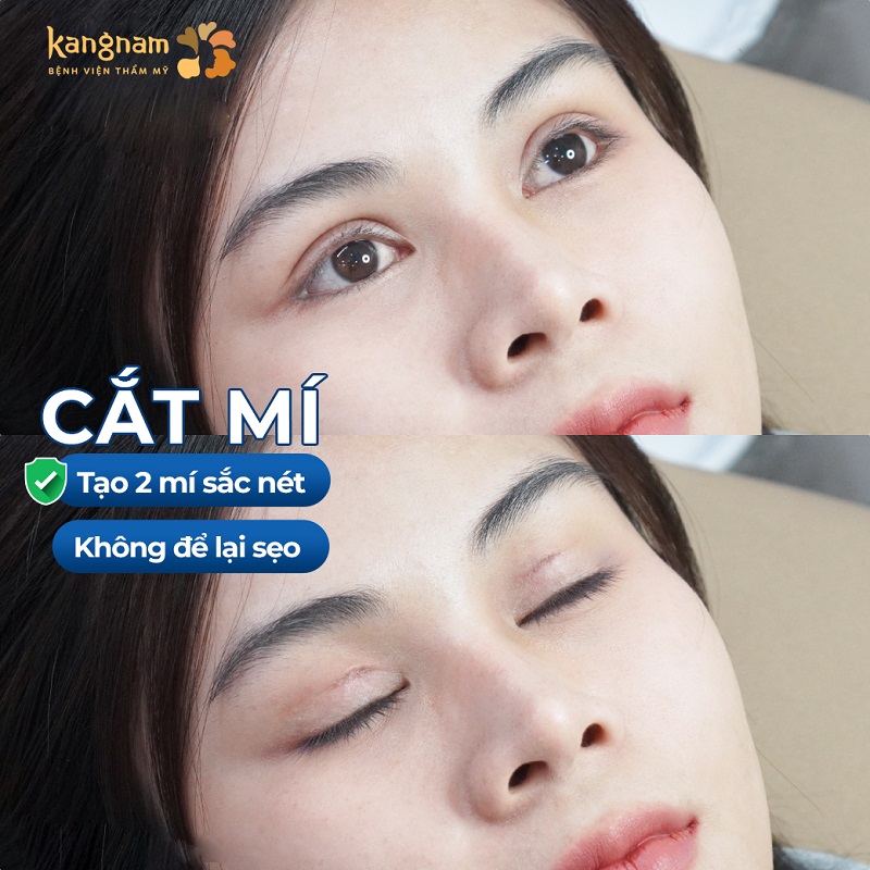 Cắt mí tại Kangnam chỉ sau 1 tháng nếp mí đã vào form đẹp tự nhiên