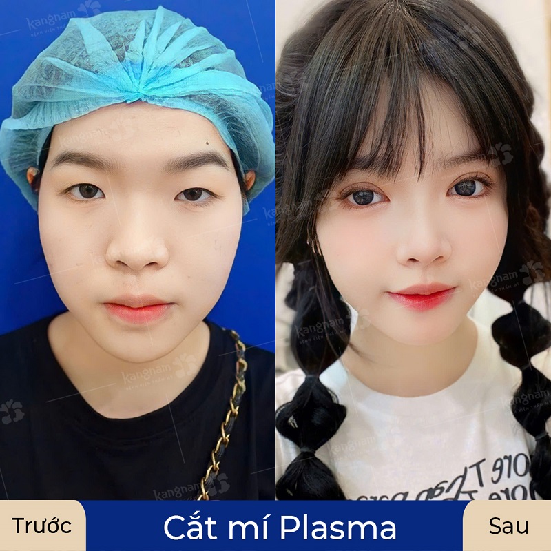 Nếp mí cân đối với tổng thể khuôn mặt