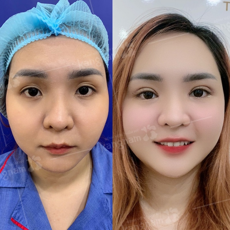 Ăn uống khoa học giúp mí mắt nhanh liền và vào form