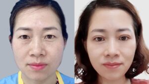 Cắt mí sau 6 tháng đã đẹp và ổn định chưa