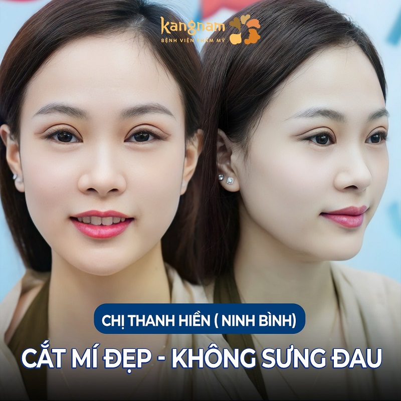 Nếp mí đã ổn định và không còn sưng đau