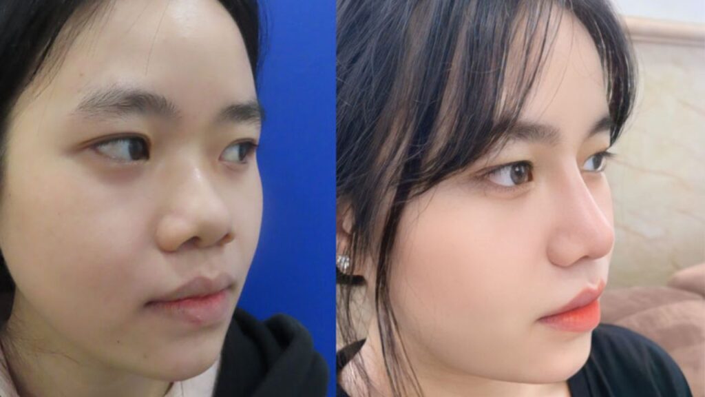 Có nên nâng mũi không? Một số lưu ý quan trọng