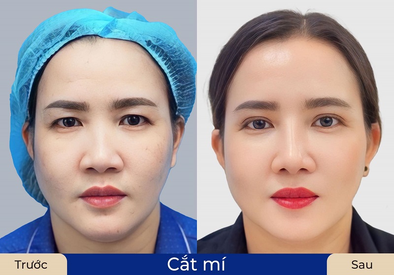 Nếp mí tự nhiên, cân đối khắc phục tình trạng chùng nhão, nhiều da thừa