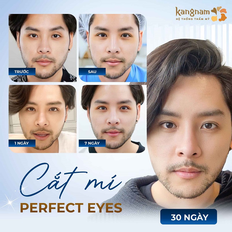 Mí mắt sau khi cắt 1 tháng để ổn định và vào form