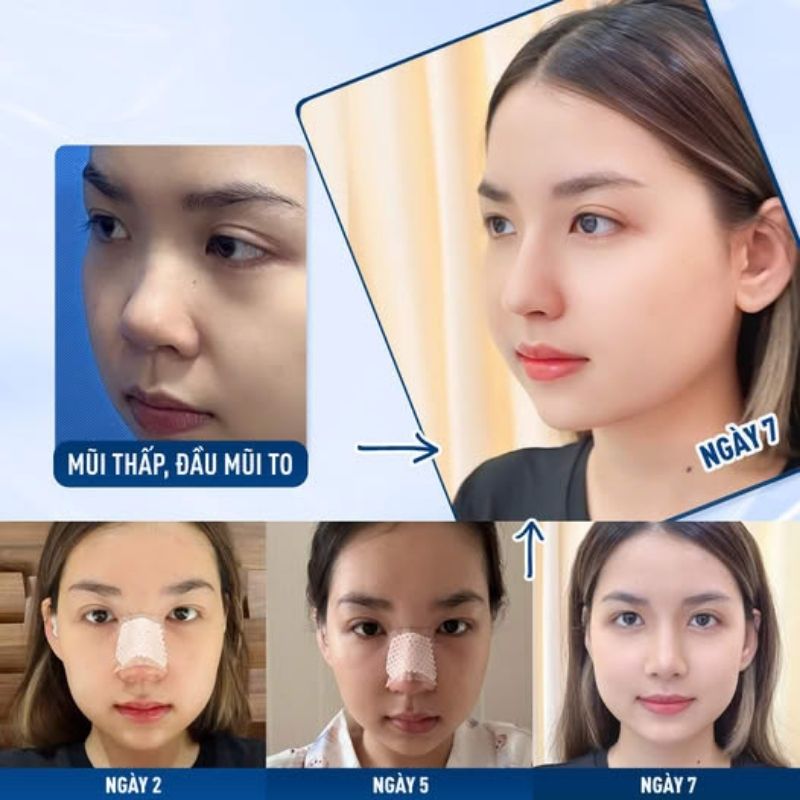 Dáng mũi đẹp tự nhiên, lành nhanh – kết quả thực tế tại Kangnam
