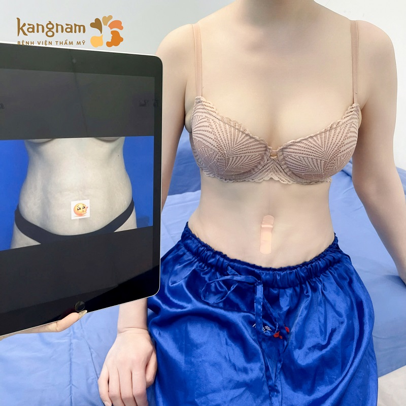 Vùng bụng phục hồi ổn định khi tuân thủ theo hướng dẫn của bác sĩ