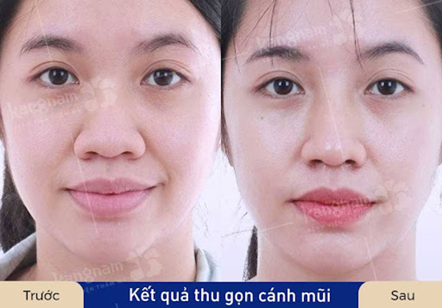 Có nhiều yếu tố ảnh hưởng đến mức giá cắt cánh mũi