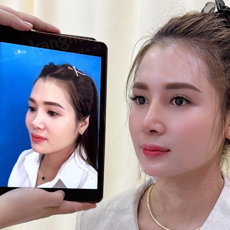 Dáng mũi cao thon, hài hòa với gương mặt sau 2 tuần hậu phẫu