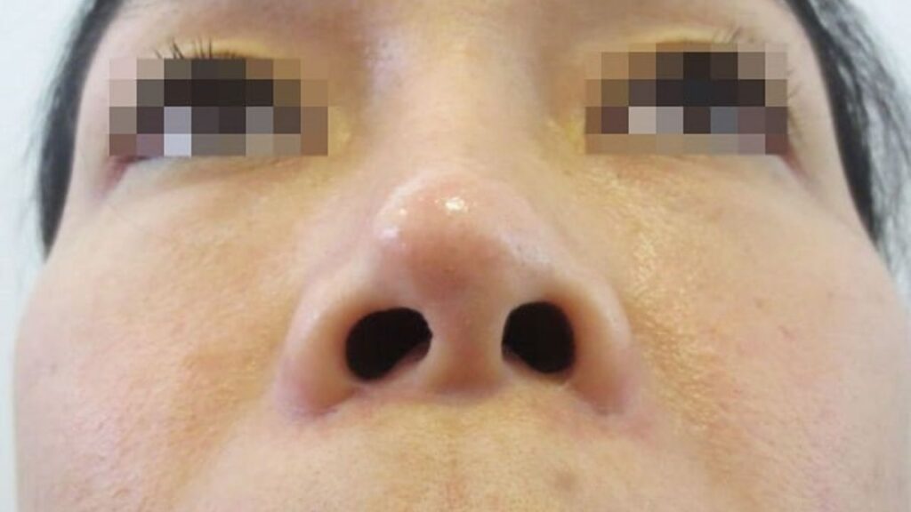 Lộ sụn đầu mũi là gì: Dấu hiệu nhận biết và cách khắc phục an toàn