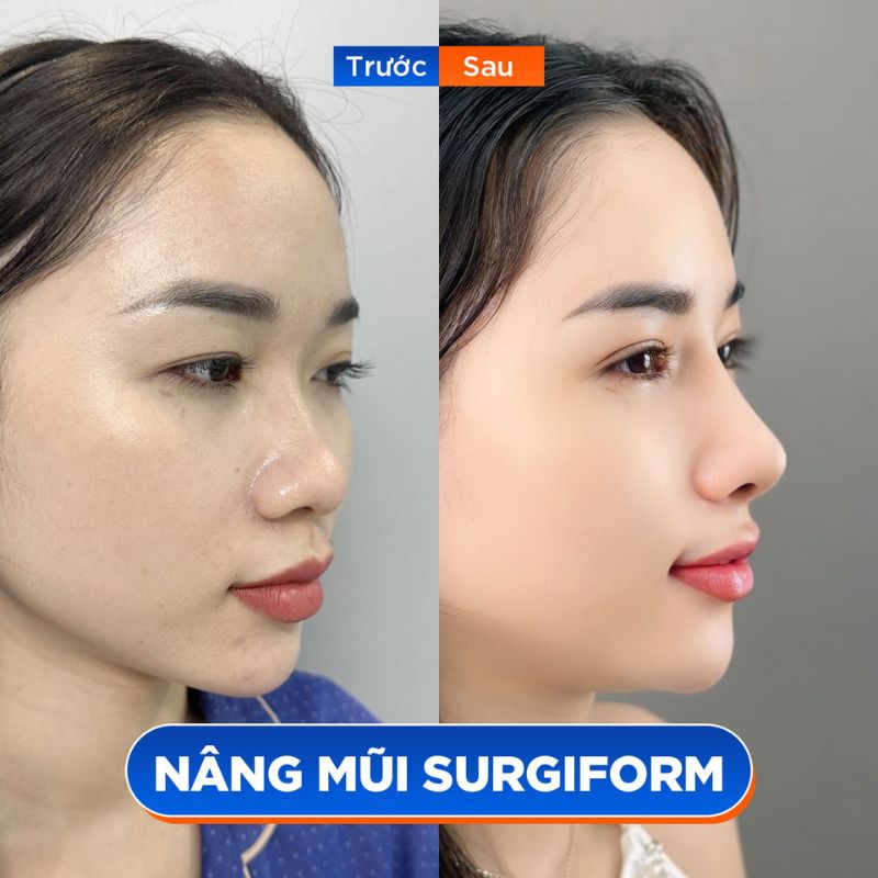 Dáng mũi cao tự nhiên, hạn chế tối đa biến chứng lộ sống