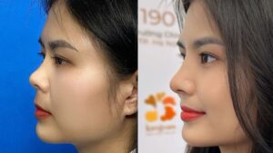 Nâng mũi gom lại có thấp không? Sự thật bạn cần biết