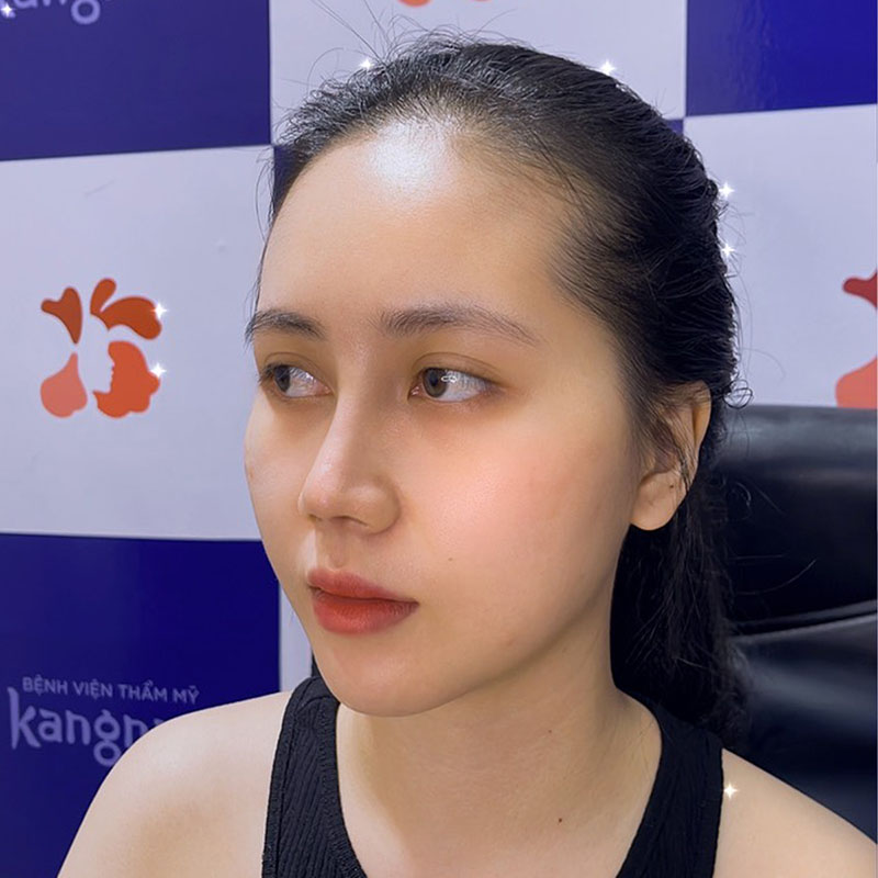 Mũi không thấp đi sau khi gom lại và ổn định