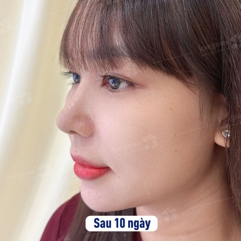 Dáng mũi 10 ngày đã giảm sưng
