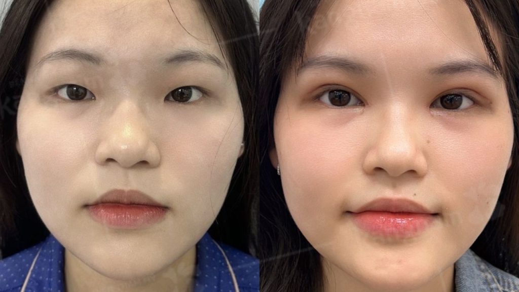 Nhấn mí mắt bao lâu thì lành hoàn toàn? các mốc thời gian quan trọng