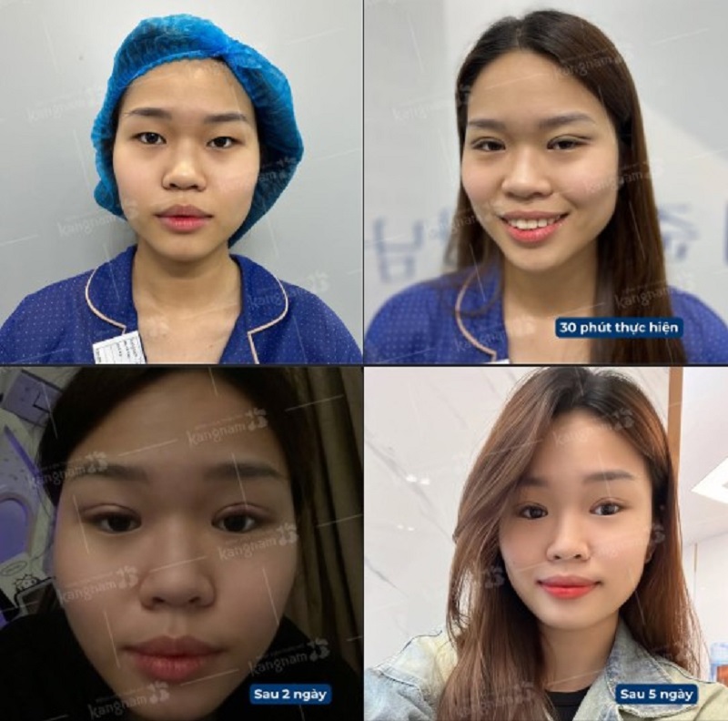 Nhấn mí sẽ lành sau vài tuần và ổn định, vào nếp tự nhiên