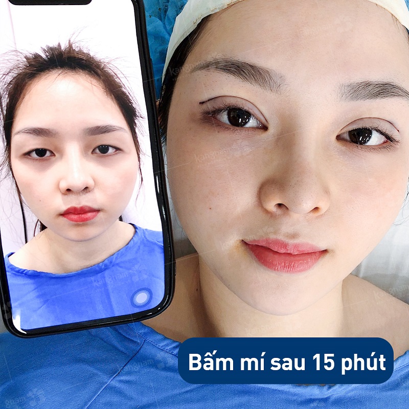 Khách hàng sau khi nhấn mí tại Kangnam