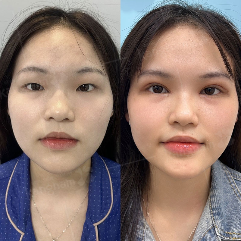 Khách hàng chăm sóc đúng cách giúp nếp mí nhanh lành