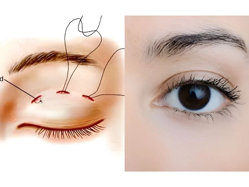 Kỹ thuật nhấn mí hiện đại giúp quá trình hồi phục diễn ra nhanh