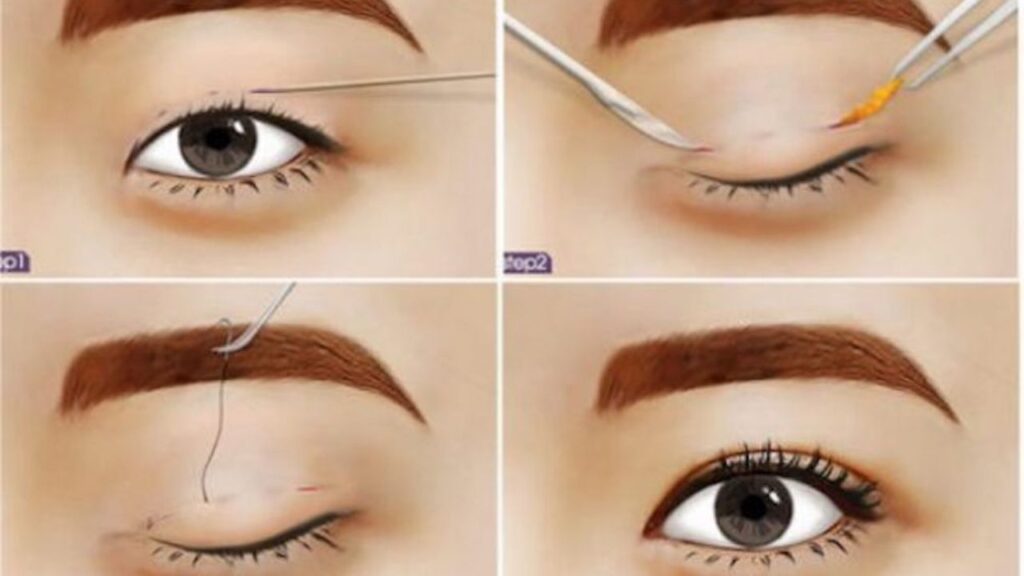 Nhấn mí có cần cắt chỉ không? một số lưu ý sau khi nhấn mí