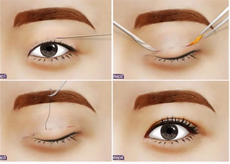 Nhấn mí dùng chỉ sinh học để liên kết nên không cần cắt chỉ