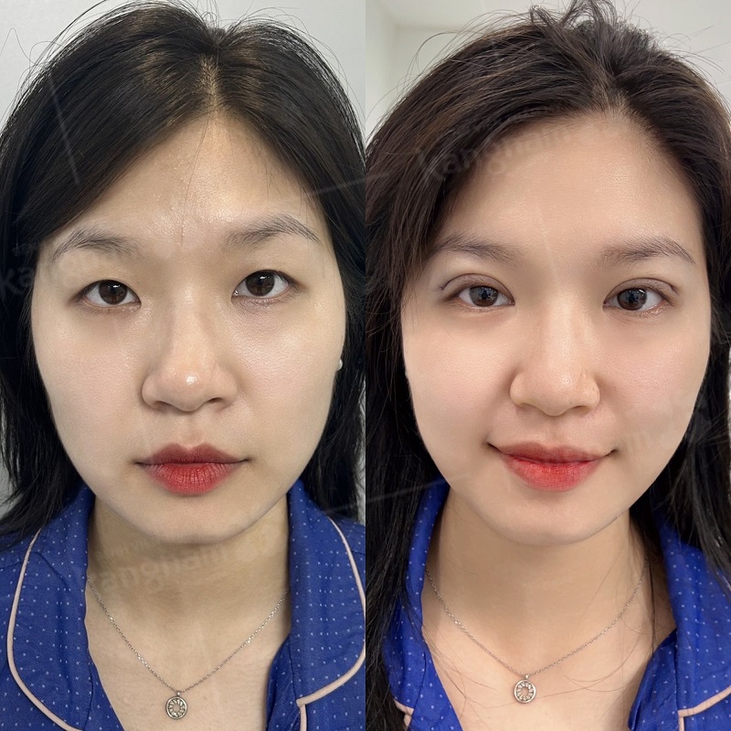 Nhấn mí tại Kangnam dùng chỉ sinh học cao cấp, rút ngắn thời gian phục hồi