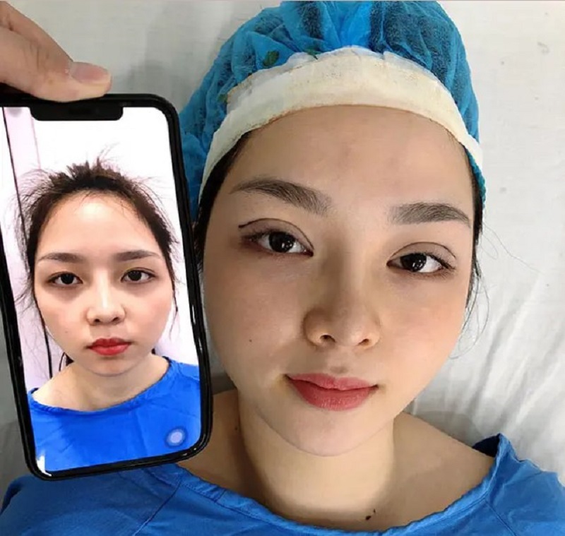 Kangnam thực hiện nhấn mí mang lại hiệu quả lâu dài