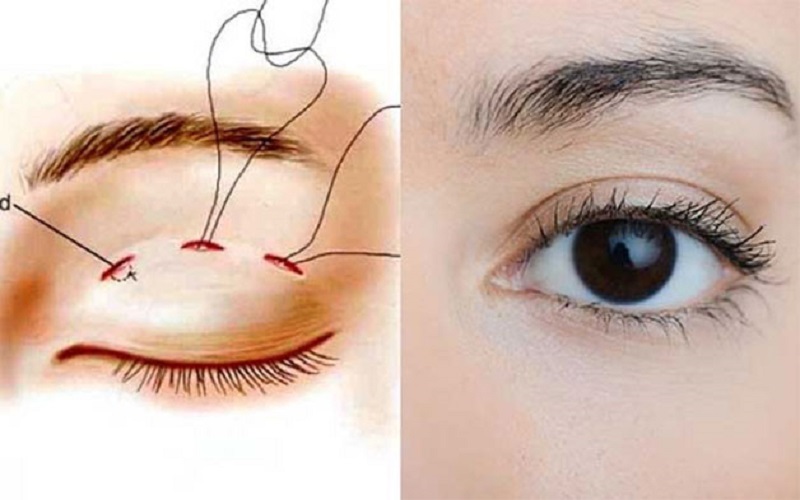 Nhấn mí Plasma có thể duy trì trong vài năm