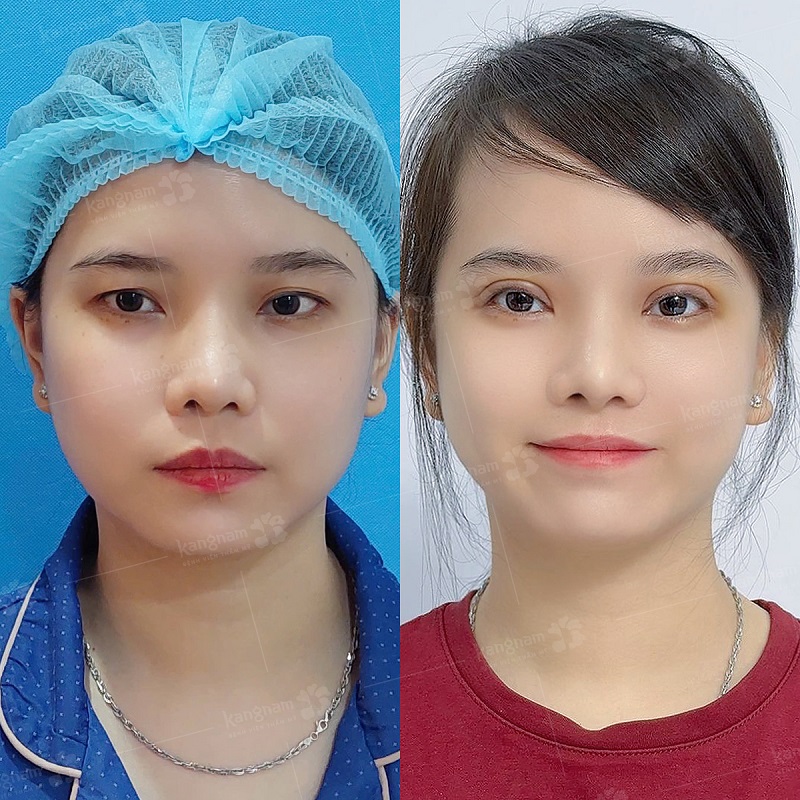 Cắt mí giúp khắc phục tình trạng da thừa, sụp mí