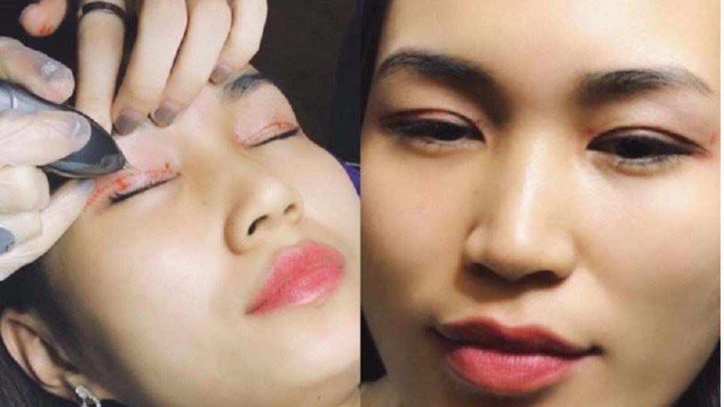 Nhấn mí Plasma giữ được bao lâu? các mốc thời gian quan trọng