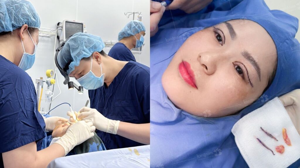 Cắt mí mắt là gì? Quá trình cắt mí diễn ra như thế nào