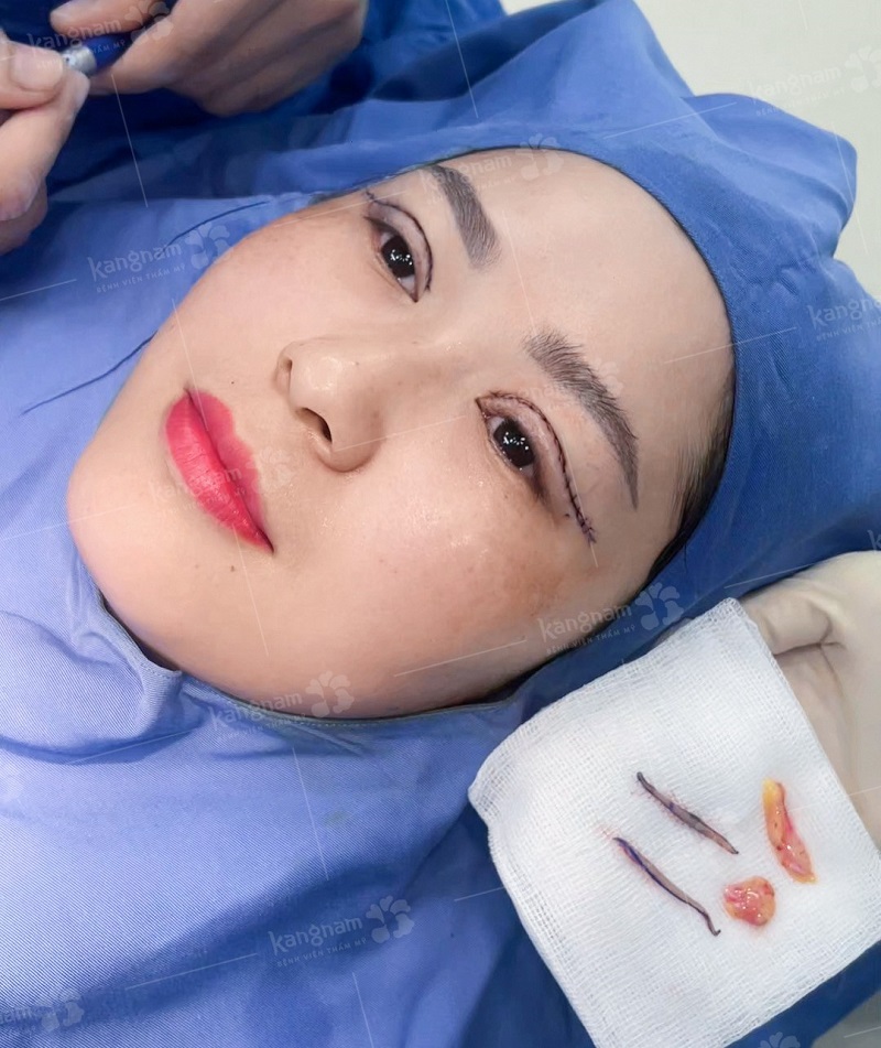 Phẫu thuật cắt mí giúp loại bỏ da thừa, mỡ dư ở mí mắt