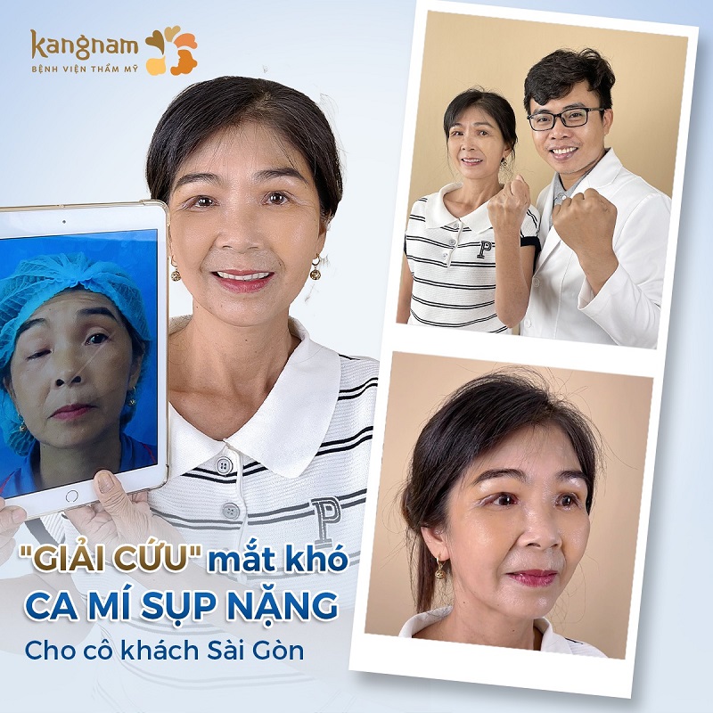 Kangnam khắc phục được những ca mí mắt khó