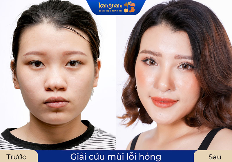 Kangnam đã tiếp nhận nhiều ca sửa mũi hỏng