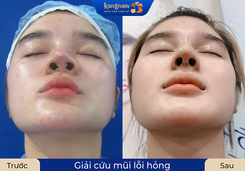 Chỉnh sửa mũi lộ sụn bằng cách thay thế sụn tự thân bọc đầu mũi