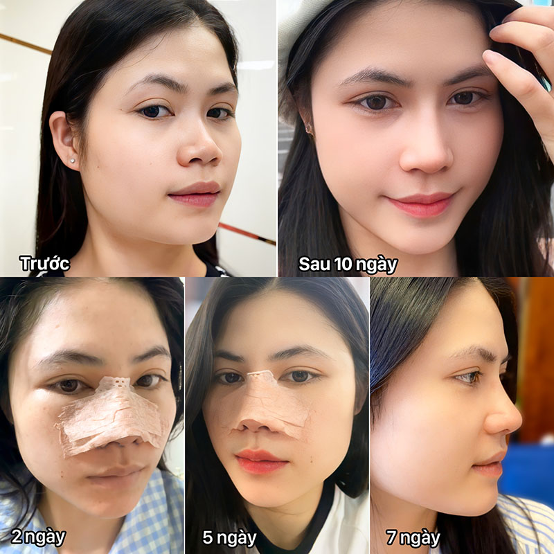 Khách hàng sau nâng mũi, đầu mũi nhỏ gọn, không còn sưng tấy