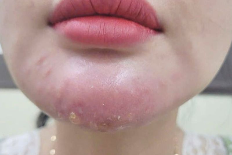 Biến chứng khi tiêm filler sai cách