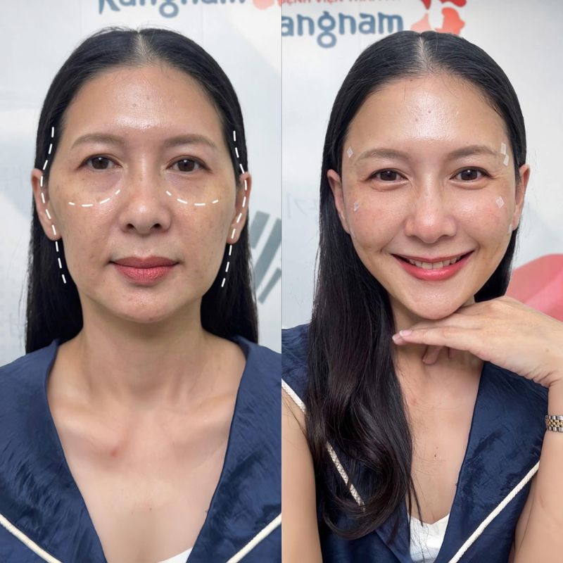 Người có các vùng lõm, hóp trên gương mặt có thể cân nhắc tiêm filler