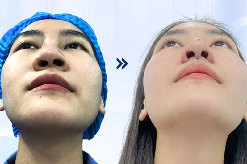 Lỗ mũi to, thô, nên cân nhắc cắt cánh mũi