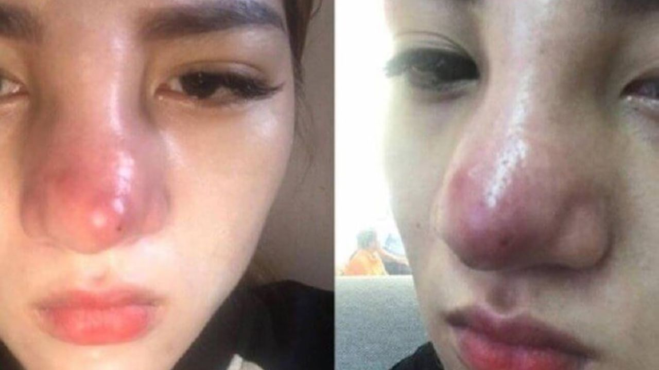 7 Dấu hiệu nâng mũi bị viêm cần nhận biết sớm